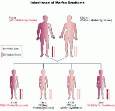 Marfan Syndrome Physiopedia