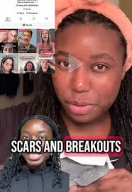 How @Dillon Mooney uses the Banish Kit 2.0 to get rid of his acne scar...