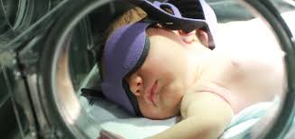 Image result for Kernicterus