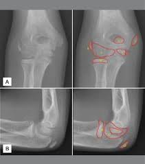 In tennis elbow, the tendons on the outside of the elbow (the lateral epicondyle) are affected. Anterior Posterior A And Lateral B Elbow Radiographs Of A Boy With Download Scientific Diagram