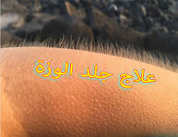 تجربتي في علاج جلد الوزة أسباب ظهور جلد الاوزة عالم حنان 1