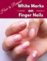 How To Remove White Marks On Finger Nails White Marks On Nails White Marks On Fingernails Foot Remedies