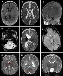 Image result for Chorioamnionitis