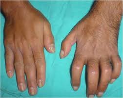 Crps Pain Syndrome Reflex Dystrophy Binding Tissue Diseases Nobindeveis Diseases En