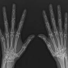 Rheumatoid arthritis can be difficult to diagnose because many conditions cause joint stiffness and inflammation and there's no definitive test for the condition. Ultrasonography In Monitoring Chronic Rheumatoid Arthritis Healthmanagement Org
