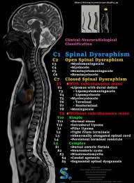 Image result for Dysraphism