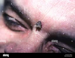 Image result for cornu cutaneum)