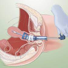 Each single use rumi uterine manipulator tip is manufactured with a usp class vi. Rumi Ii System Uterine Manipulator Healthcare21
