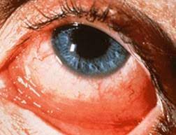 Allergic Conjunctivitis American Association For Pediatric Ophthalmology And Strabismus