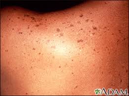 Image result for liver spots on legs
