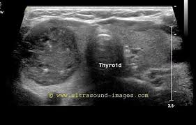 A Gallery Of High Resolution Ultrasound Color Doppler 3d Images Thyroid Thyroid Ultrasound Diagnostic Medical Sonography Thyroid