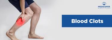 111 will tell you what to do. Blood Clots Causes Diagnosis Treatment Prevention Symptoms