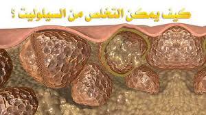 ما هو السيلوليت كيفيه التخلص من السيلوليت بنات كول