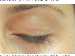 This narrated video demonstrates how to select the appropriate weight for an upper lid gold weight or platinum chain. Pdf Custom Made Gold Implant For Management Of Lagophthalmos A Case Report Semantic Scholar