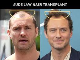 Jude Law Hair Transplant
