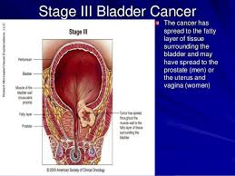 Symptoms of bladder cancer may include passing blood in your urine. Bladder Carcinoma