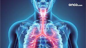 It may also have spread to distant sites, such as the lungs. Stage 4 Throat Cancer Metastatic Throat Cancer Onco Com