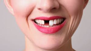 Check spelling or type a new query. Do Brits Really Have Bad Teeth Bbc Future