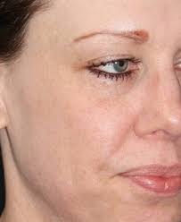 PicoWay Laser Treatments in Grand Cayman » BodyBarn Medi Spa