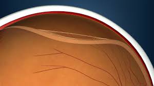 Feb 05, 2020 · in graves disease, swelling, fibrosis, and scarring of the tissue behind the eye muscles surrounding the eye may occur. Macular Pucker Diagnosis And Treatment Brightfocus Foundation