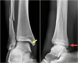 Weber a variant lateral malleolus fractures present another clinical dilemma. The Radiology Assistant Weber And Lauge Hansen Classification
