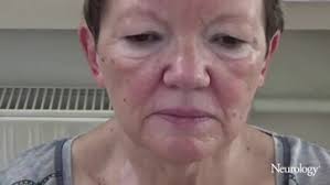 Delayed Benefit From Aggressive Immunotherapy in Waxing and Waning  Anti-IgLON5 Disease