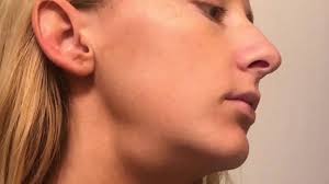 Frau (26) ertastet bei sich Krebs im Stadium 4: Dank trendigen  Gua-Sha-Massagen auf TikTok