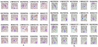 Blood Slide Image Analysis to Classify WBC Types for Prediction Haematology  Based on a Hybrid Model of CNN and Handcrafted Features