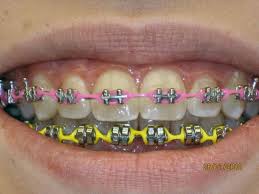 4 Braces Braces Bands Pink Braces Braces Colors