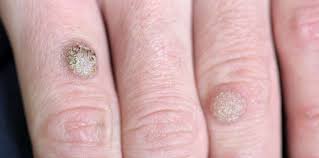 Check spelling or type a new query. Seborrheic Keratosis Symptoms Causes Treatments Clear Skin Clinic