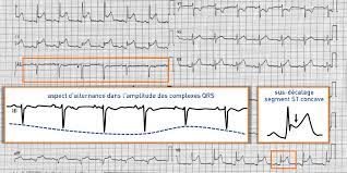 Learn the symptoms, causes, diagnosis and treatments for this condition. Douleur Thoracique Sus Decalage Du Segment St Et Pericardite Aigue Cardiocases