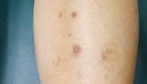 Image result for liver spots on legs