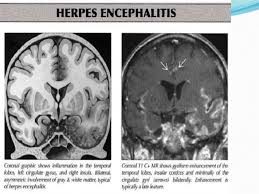 Mri showing extensive necrotizing sequelae. Imaging Of Cns Viral Infection