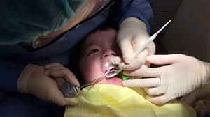 李鈞豪2歲去看牙齒-2018年7月24日