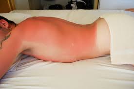 Solnechnyj Ozhog I Ego Posledstviya Zdoroveinfo