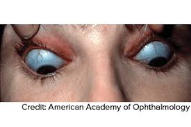 Image result for Sclera