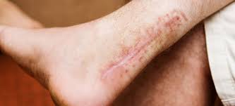 Wann eine konservative infrage kommt und wann eine operation nötig ist. Achillessehnenriss Ursachen Behandlung