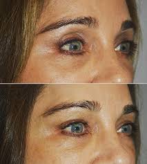 Check spelling or type a new query. Tabanmd On Instagram Upper Eyelid Filler Injection To Correct Sunken Hollow Upper Eyelids After Previous Uppe Injectables Fillers Botox Fillers Upper Eyelid