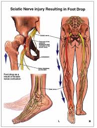 Pin On Foot Drop