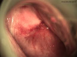 Cervical cancer treatment modalities include surgery, radiation therapy, chemotherapy and targeted therapy. Large Pelvic Mass Arising From The Cervical Stump A Case Report