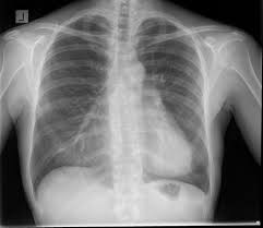 Sternum (plural sterna or sternums). Depressed Sternum Radiology Case Radiopaedia Org