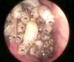 Masalah resdung berpunca dari alahan terhadap habuk,debu, pemakanan, pencemaran dan sebagainya. Besar Ulat Ulat Yang Kementerian Kesihatan Malaysia Facebook