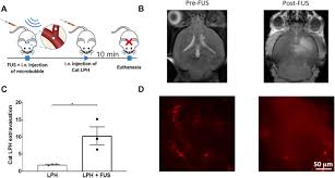 Most headaches, however, are not a sign of a tumor or cancer. Single Cell Analysis Reveals Effective Sirna Delivery In Brain Tumors With Microbubble Enhanced Ultrasound And Cationic Nanoparticles Science Advances