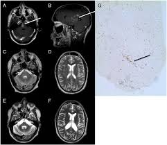 Radiology department of the rijnland hospital, leiderdorp and the onze lieve vrouwe gasthuis, amsterdam, the netherlands. Clippers Among Patients Diagnosed With Non Specific Cns Neuroinflammatory Diseases Journal Of The Neurological Sciences