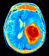 Brain tissue dysfunction caused by a growing tumor may cause other symptoms, depending on the tumor's location. The 10 Deadliest Cancers That Affect Kids And How To Spot The Signs In Your Child