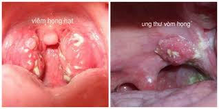 Bệnh hay gặp ở nam giới. Phan Biá»‡t Ung ThÆ° Vom Há»ng Va Viem Há»ng Thong ThÆ°á»ng Vinmec