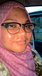 Kalau tak kena cara, habis satu badan cepat merebak dek kerana asyik menggaru. Pantang Larang Sarahnursaad