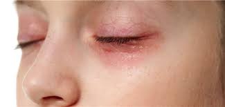 Jun 28, 2021 · sie bekam einen ausschlag am ganzen körper und ihr zahnfleisch begann, sich zu verfärben. Erneut Anaphylaxie Nach Covid 19 Impfung