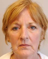 Burns, permanent changes to your skin color, and scars can occur. Rapid City Sd Laser Skin Resurfacing Hunter Moyer Md