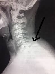 Check spelling or type a new query. Q A Spinous Process Fracture The Physical Therapy Advisor